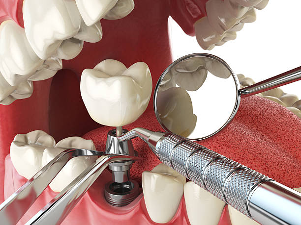 Best Knocked-Out Tooth Emergency  in Monroe, LA